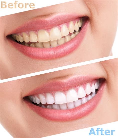 Teeth Whitening Herndon Va Cosmetic Dentistry Philips Zoom