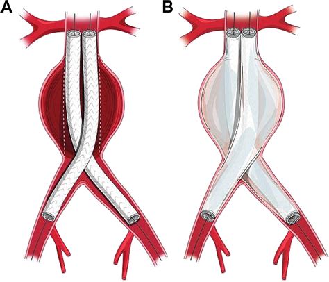 Endovascular Aneurysm Sealing For Infrarenal Abdominal Aortic Aneurysms Hot Sex Picture