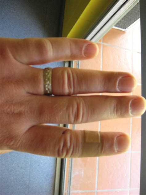 Left Pinky Finger Swelling