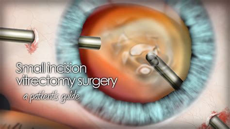 Retina Surgery In Tampa Bay Florida