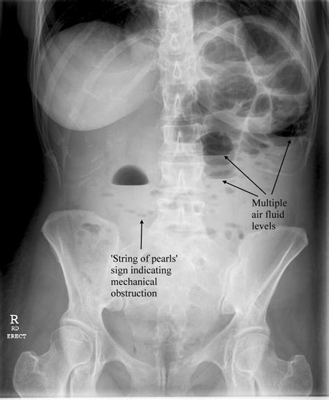 Acute Abdomen Overview