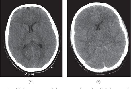 Figure 2 From Increased Intracranial Pressure During Hemodialysis In A