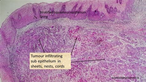 Pathology Of Esophageal Squamous Cell Carcinoma Pathology Made Simple