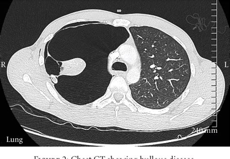 Figure 2 From A Rare Case Of Vanishing Lung Syndrome Semantic Scholar