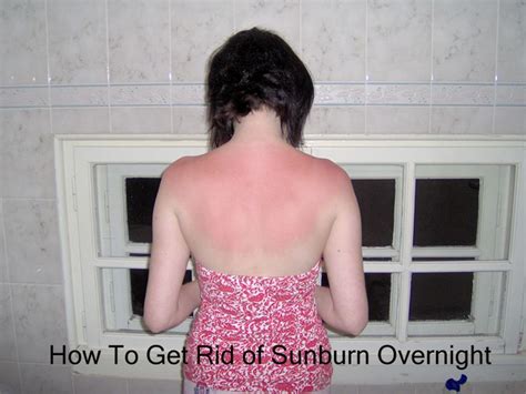 How To Get Rid Of Sunburn Overnight 10 Best Ways To Heal Its Redness