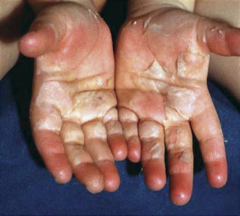 recurrent toxin mediated perineal erythema eleven pediatric cases dermatology jama