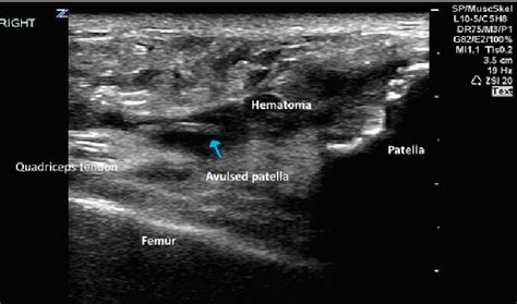 Bedside Ultrasound Diagnosis Of Quadriceps Tendon Rupture And Avulsed