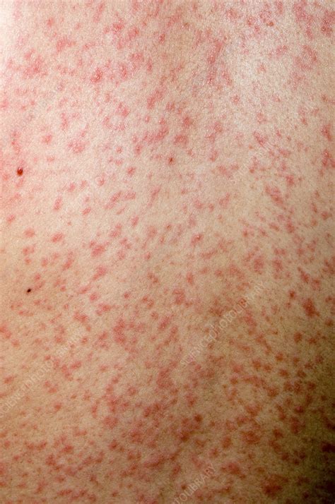 Measles Rash Stock Image M2100361 Science Photo Library