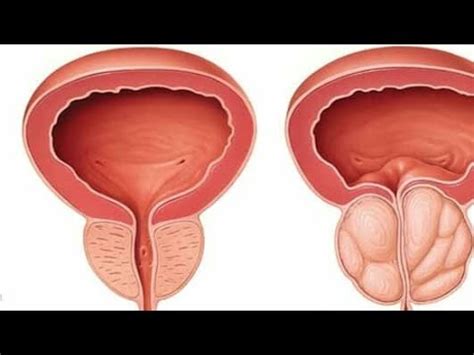 البروستات غدة تابعة للجهاز التناسلي الذكري تقع تحت المثانة وتقوم بإفراز جزء من السائل المنوي. علاج التهاب البروستات بالثوم - YouTube