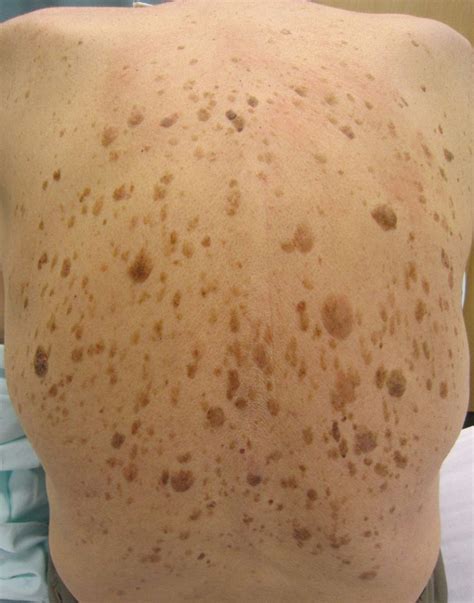 Causes Prevention And Treatment Of Brown Spots On Skin