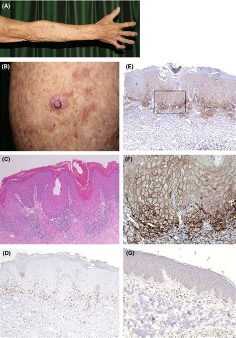 Hypertrophic Lichenoid Dermatitis During Pembrolizumab Treatment