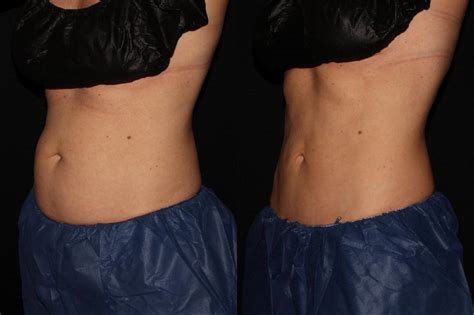 CoolSculpting Before And After Pictures Case Chico Yuba City Oroville CA Hodari MD
