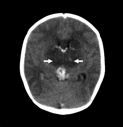 Diagnosis And Management Of Cerebral Venous Thrombosis Stroke