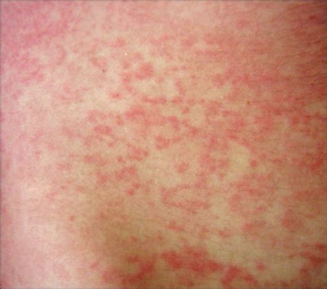 Rash After Using Amoxicilline In Patient With Infectiou Open I