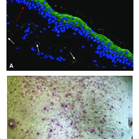 Demonstration Of Skin Rash Induced By Anti Egfr Treatment Cetuximab