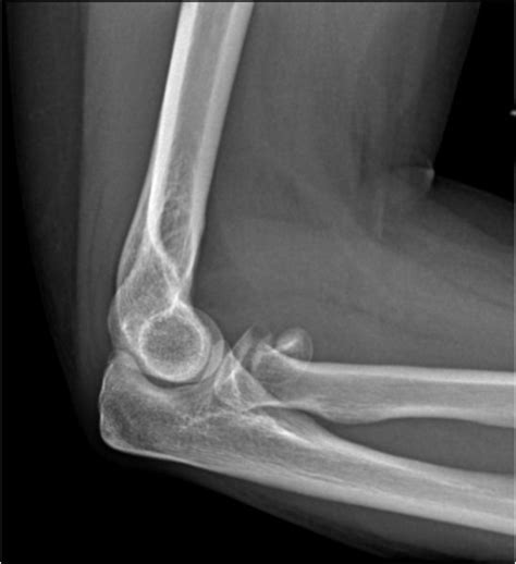 Elbow Radial Head Fracture Doctorvisit
