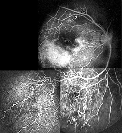 Corkscrew Retinal Vessels In Neurofibromatosis Type 1 Report Of 12