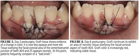 Healing Progression Of The Free Gingival Graft Decisions In Dentistry