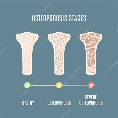 Osteoporosis Illustration Stock Image F0336068 Science Photo