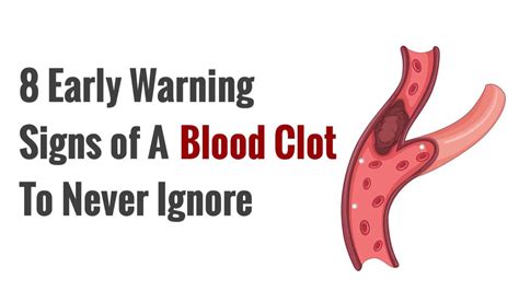 8 Early Warning Signs Of A Blood Clot To Never Ignore