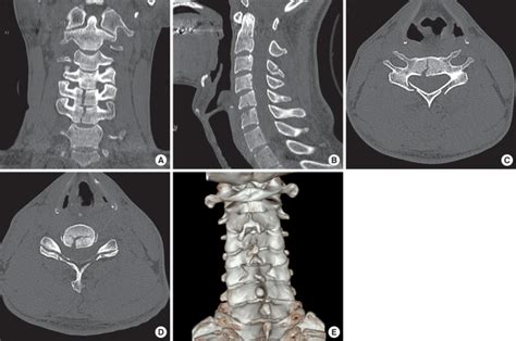 Cervical Spine Computed Tomographic Ct Scans With 3 Dimensional 3 D