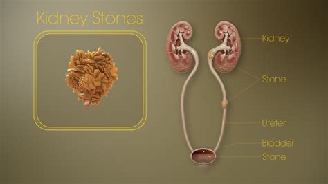 Kidney Stones Causes Symptoms Treatment And Medication