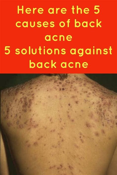 What Are The 5 Causes Of Back Acne How To Treat Back Acne At Home