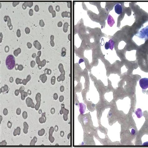 Peripheral Blood And Bone Marrow Aspirate Revealed Large Sized Atypical