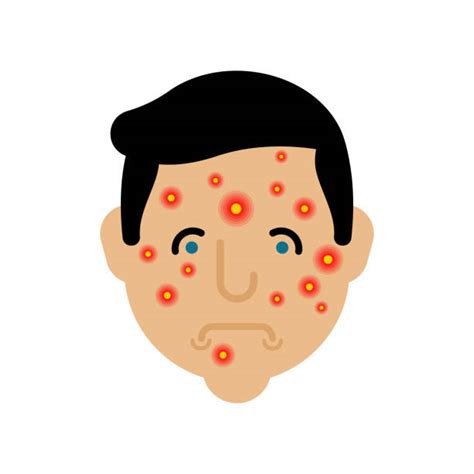 Chicken Pox Illustrations Royalty Free Vector Graphics And Clip Art Istock