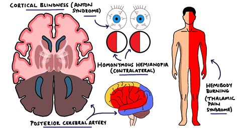 Posterior Cerebral Artery Stroke Syndromes Pca Stroke Syndromes