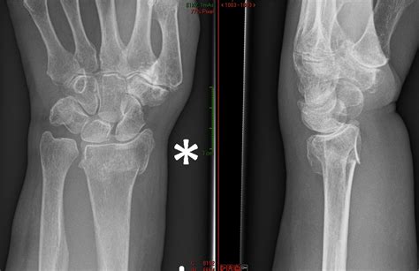 Right Distal Radial Fracture