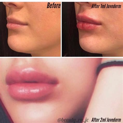 0.5 Ml Lip Fillers Before And After 1Ml