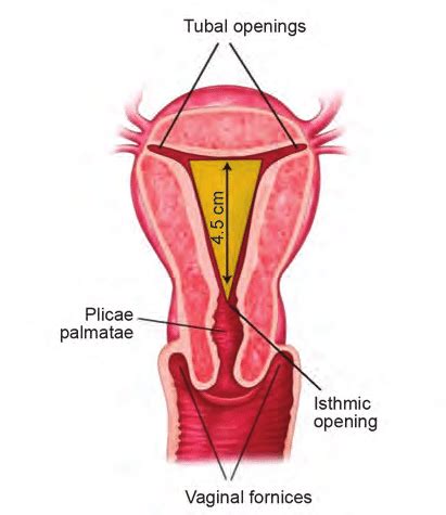 Uterine Cavity Seen As Inverted Triangle Download Scientific Diagram