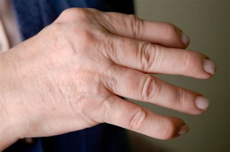 Psoriatic Arthritis Types Symptoms Diagnosis And Treatment Extrachai
