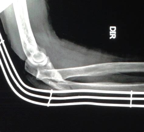 Dicas De Radiologia Tudo Sobre Radiologia Imagens Radiol Gicas Fratura Ulna Cotovelo