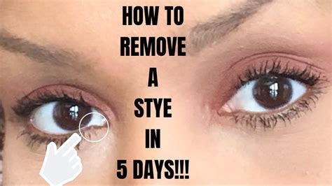 How To Remove An Eye Stye In 5 Days Youtube