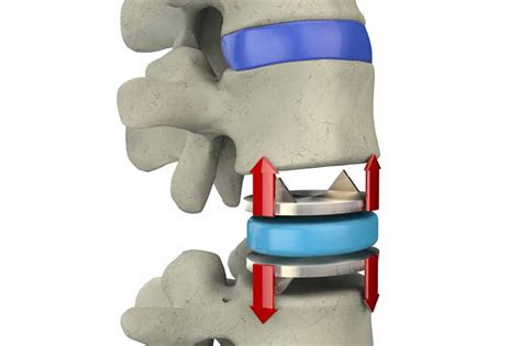 5 Reasons For Revision Spine Surgery Bonati Spine Institute
