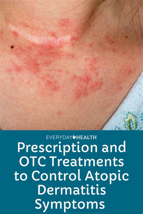Prescription And Otc Treatments To Control Atopic Dermatitis Symptoms