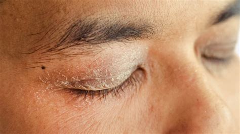 Causes Of Rash Around Eyes Symptoms And Treatment