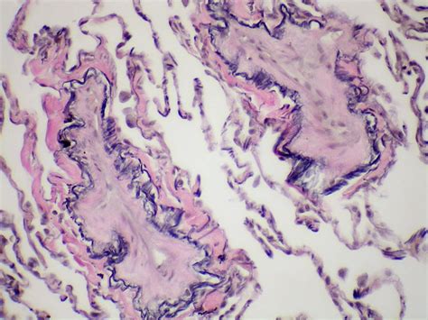 Pulmonary Veno Occlusive Disease Pvod Elastic Tissue Stain Case 269