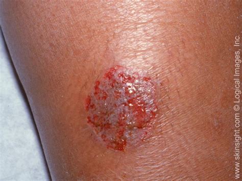 Nummular Eczema Symptoms And Causes National Eczema Association