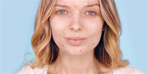 Acne Tips For Managing Dermatology Physicians Group Chicago Illinois