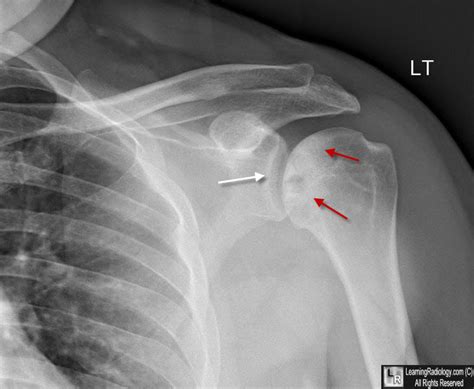 Learning Radiology Avascular Necrosis Avn Shoulder