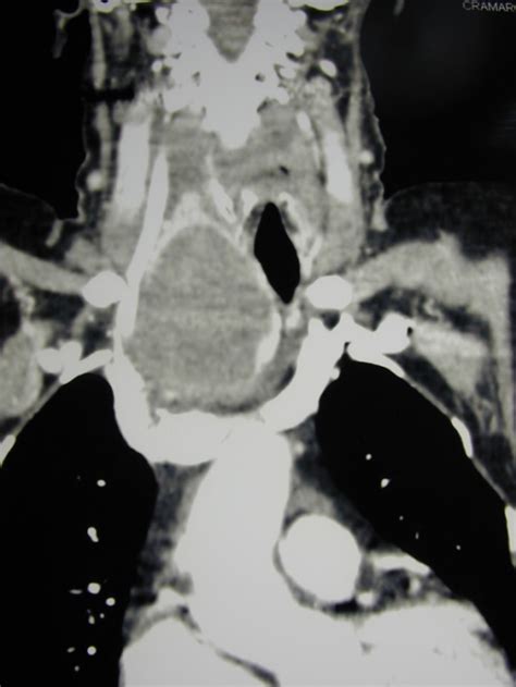 Contrast Enhanced Ct Scan Coronal Reconstructed Image Open I