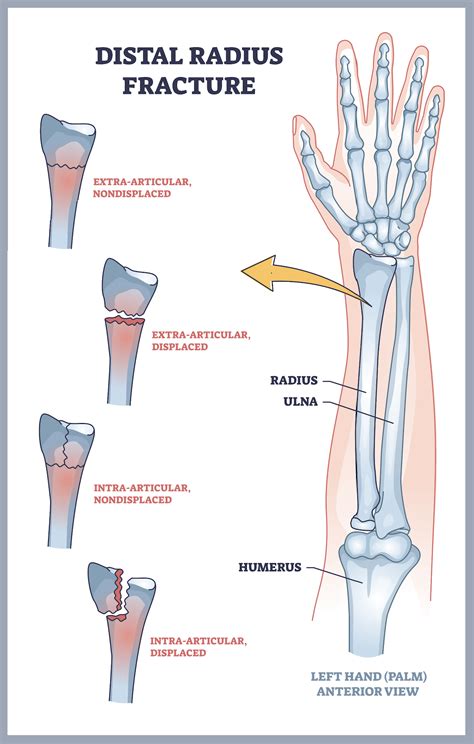 Wrist Sprain Vs Wrist Fracture Advanced Ortho And Spine