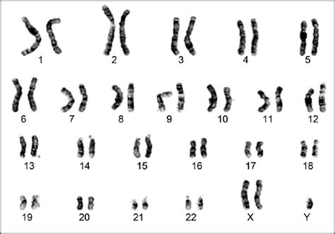 Filekaryotype Of A Klinefelters Syndrome Patient Embryology