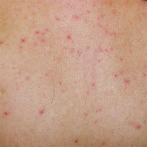 Skin Rashes Caused By Viral Infection Healthy Living