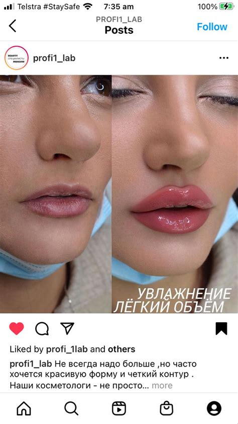 What Is The Best For Lip Fillers Marianela Eagle