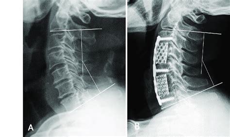 Cervical Lordosis Was Quantified By Measuring The C2 C7 Cobb Angle