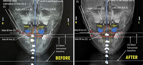 Improvement In Cervical Spinal Misalignment After The Application Of